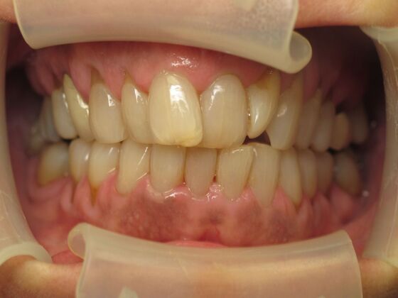 Cosmetic Crowns: Ten Upper Cosmetic Crowns for a Fuller, Brighter Smile - Before