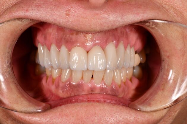 Cosmetic Crowns: Ten Upper Cosmetic Crowns for a Fuller, Brighter Smile - After