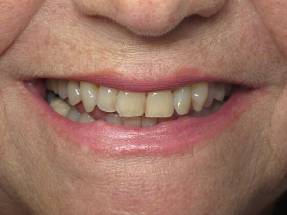 Laminates and Veneers: Porcelain Veneers for Worn and Uneven Front Teeth - Before