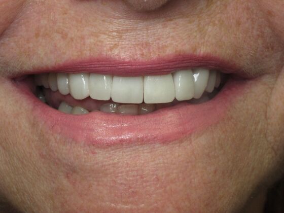 Laminates and Veneers: Porcelain Veneers for Worn and Uneven Front Teeth - After
