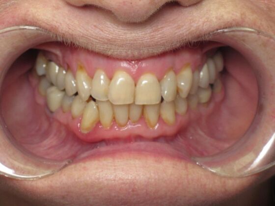 Laminates and Veneers: Porcelain Veneers for Worn and Uneven Front Teeth - Before
