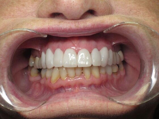 Laminates and Veneers: Porcelain Veneers for Worn and Uneven Front Teeth - After