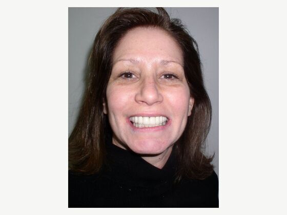Cosmetic Crowns Cosmetic Crown and Bridge for a Broader, More Confident Smile - After