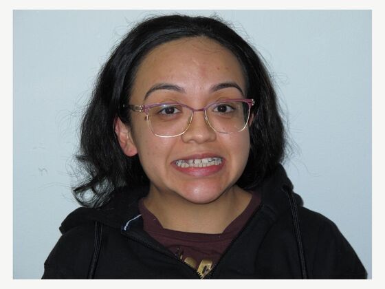 Cosmetic Crowns Cosmetic Crowns and Individual Implants for a Balanced Smile - Before