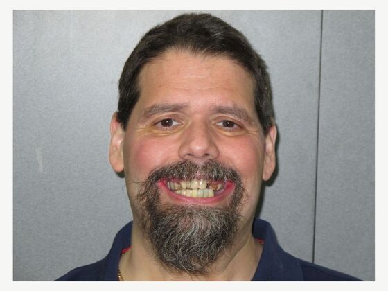 Full Mouth Implants: Full Upper and Lower Implants for a Powerful Smile Transformation - Before