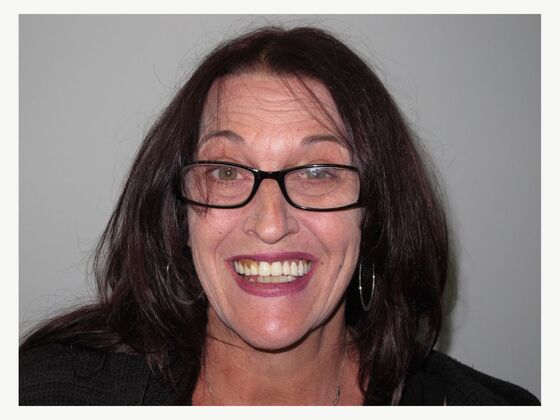 Full Mouth Implants: Lower Teeth in a Day for a Fuller Smile and More Confidence - Before