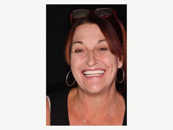 Full Mouth Implants: Lower Teeth in a Day for a Fuller Smile and More Confidence - After
