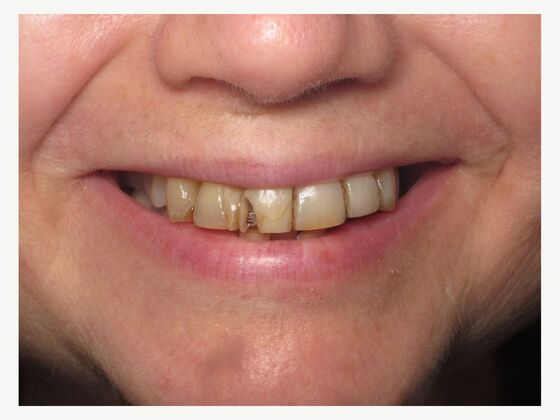 Teeth in a Day: Upper Teeth in a Day for a New Fixed Upper Smile - Before