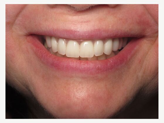 Teeth in a Day: Upper Teeth in a Day for a New Fixed Upper Smile - After