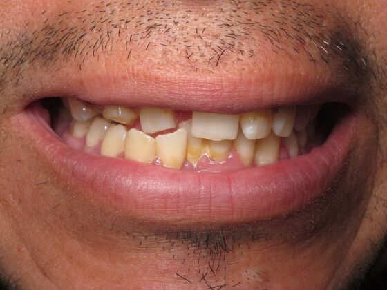 Full Mouth Implants: Full-Mouth Implant Reconstruction for Broken and Uneven Teeth - Before