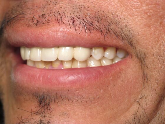 Full Mouth Implants: Full-Mouth Implant Reconstruction for Broken and Uneven Teeth - After