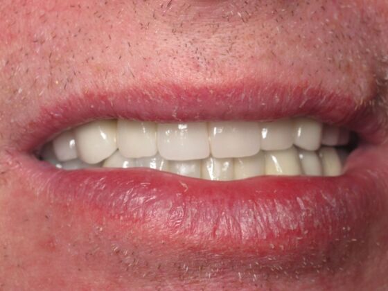Full Mouth Implants: Full-Mouth Dental Implants for Missing and Unstable Teeth - After