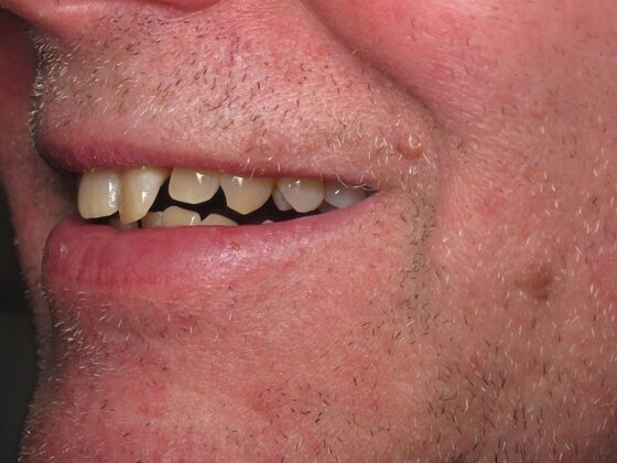 Full Mouth Implants: Full-Mouth Dental Implants for Missing and Unstable Teeth - Before