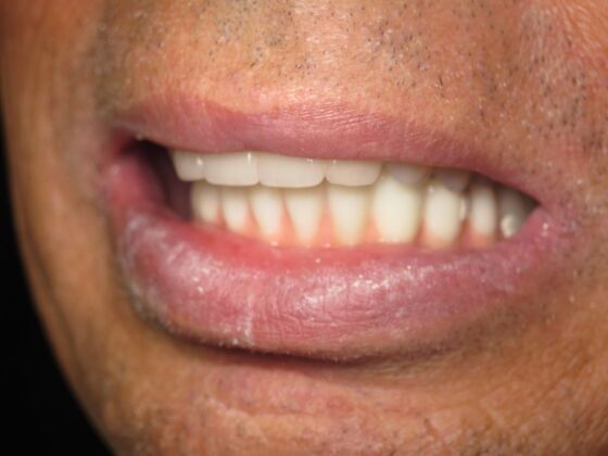 Full Mouth Implants: Full-Mouth Implant Rehabilitation for a Stronger Smile - After