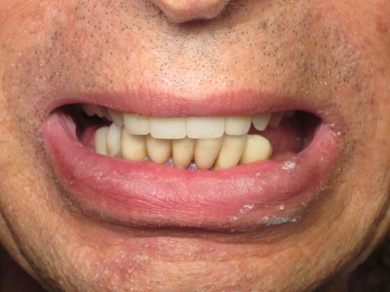 Full Mouth Implants: Full-Mouth Implant Rehabilitation for a Stronger Smile - Before