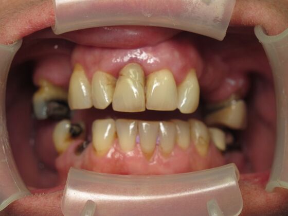 Full Mouth Implants: Full-Mouth Implant Reconstruction After Severe Dental Breakdown - Before