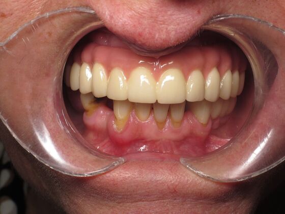 Full Mouth Implants: Full-Mouth Implant Reconstruction After Severe Dental Breakdown - After