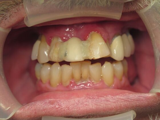 Full Mouth Implants: Full-Mouth Implant Reconstruction for Severe Wear and Missing Support - Before
