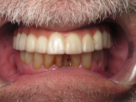 Full Mouth Implants: Full-Mouth Implant Reconstruction for Severe Wear and Missing Support - After