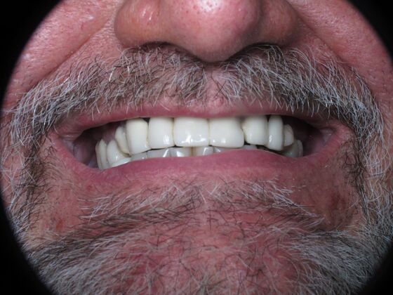Full Mouth Implants: Full-Mouth Implants to Rebuild a Failing Smile - Before