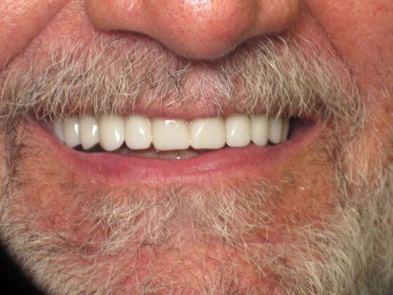 Full Mouth Implants: Full-Mouth Implants to Rebuild a Failing Smile - After