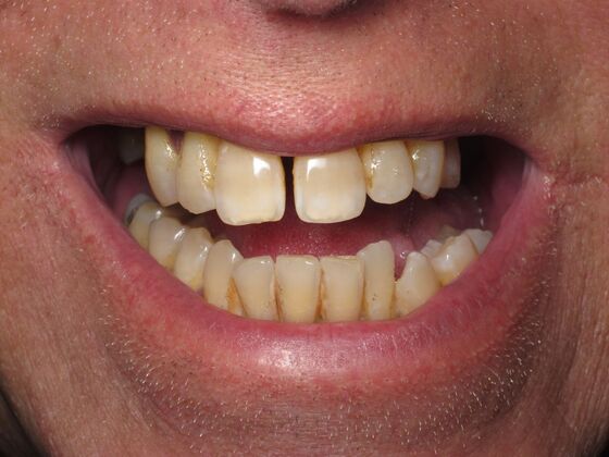 Full Mouth Implants: Full-Arch Dental Implants for Gaps, Wear, and Smile Collapse - Before