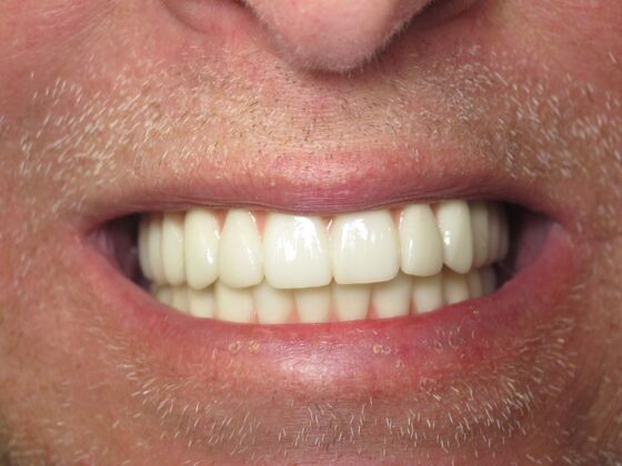Full Mouth Implants: Full-Arch Dental Implants for Gaps, Wear, and Smile Collapse - After