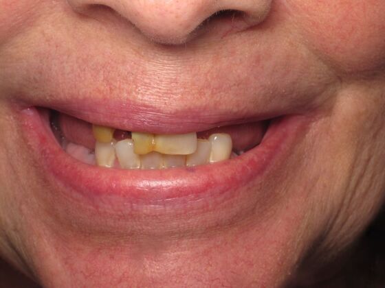 Full Mouth Implants: Full-Mouth Implants for Missing Teeth and a More Complete Smile - Before