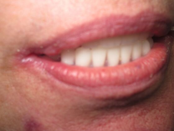 Full Mouth Implants: Full-Mouth Implants for Missing Teeth and a More Complete Smile - After