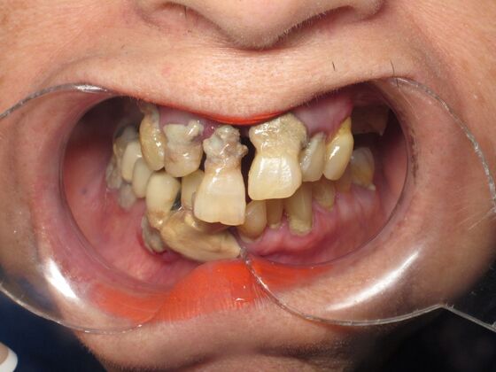 Full Mouth Implants: Full-Mouth Implant Reconstruction for Severe Tooth Breakdown - Before