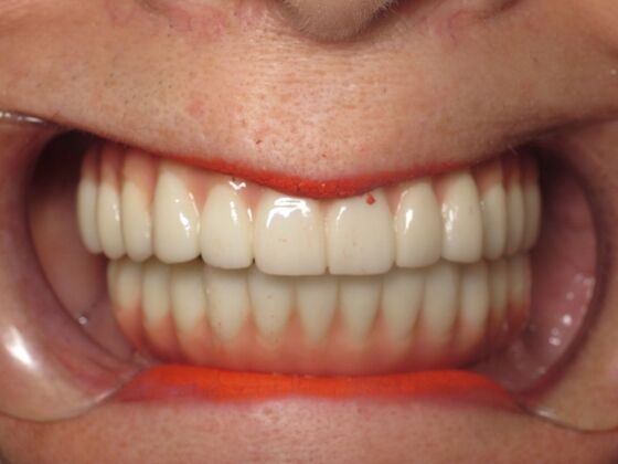 Full Mouth Implants: Full-Mouth Implant Reconstruction for Severe Tooth Breakdown - After