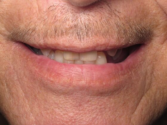 Individual Implants: Dental Implant Treatment for Missing Teeth and Smile Support - Before