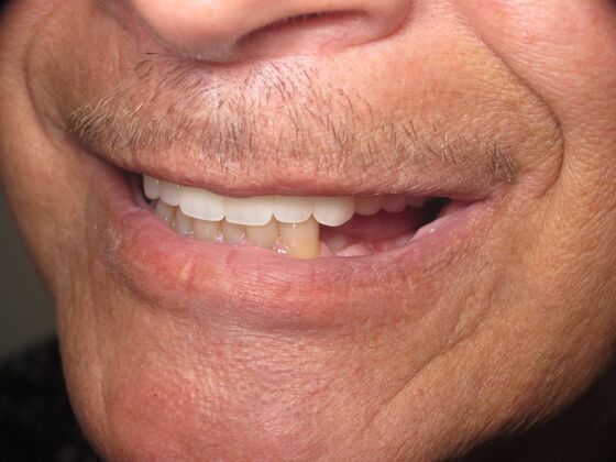 Individual Implants: Dental Implant Treatment for Missing Teeth and Smile Support - After