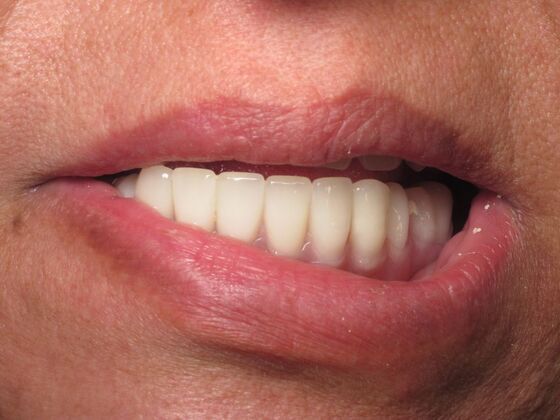 Individual Implants: Dental Implants for Missing Teeth and a Broader Smile - After