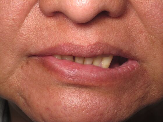 Individual Implants: Dental Implants for Missing Teeth and a Broader Smile - Before