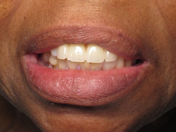 Full Mouth Implants: Full-Mouth Implant Dentistry for Uneven Teeth and Smile Support - Before