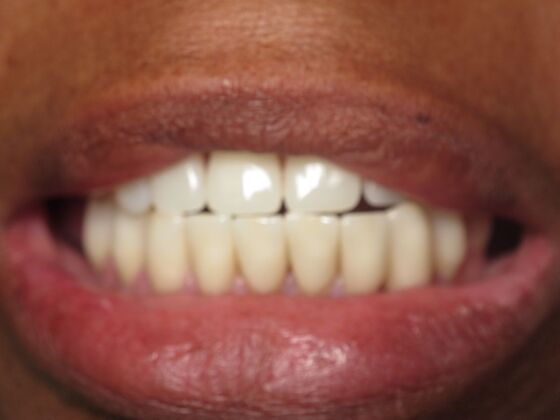 Full Mouth Implants: Full-Mouth Implant Dentistry for Uneven Teeth and Smile Support - After