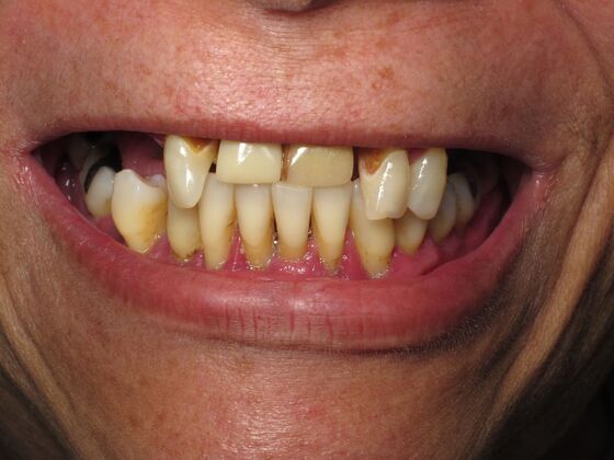 Full Mouth Implants: Full-Mouth Dental Implants for Crowding, Wear, and a Brighter Smile - Before