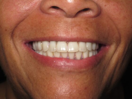 Full Mouth Implants: Full-Mouth Dental Implants for Crowding, Wear, and a Brighter Smile - After