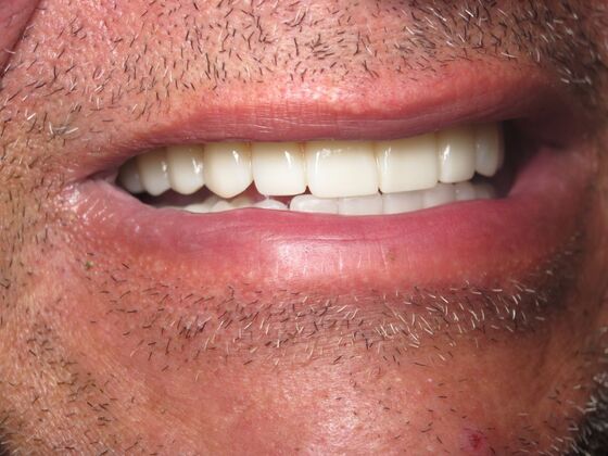 Full Mouth Implants: Fixed Implant Teeth for Severe Smile Collapse - After