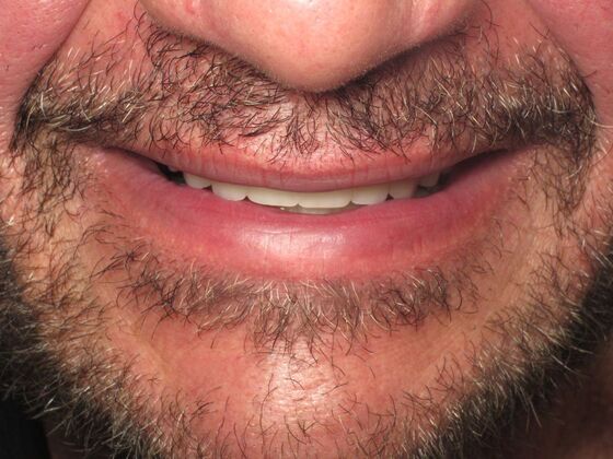 Full Mouth Implants: Fixed Implant Teeth for Severe Smile Collapse - Before