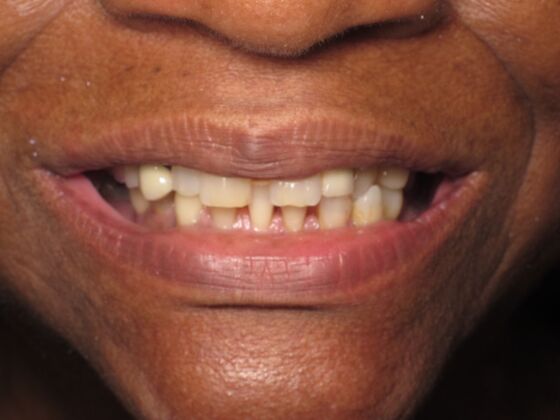 Full Mouth Implants: Full-Mouth Implant Reconstruction for Missing Front-Tooth Support - Before