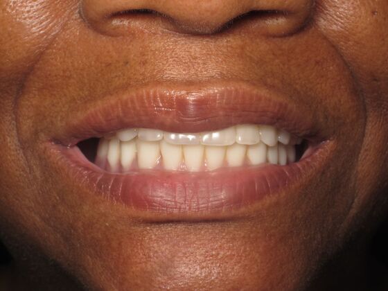 Full Mouth Implants: Full-Mouth Implant Reconstruction for Missing Front-Tooth Support - After