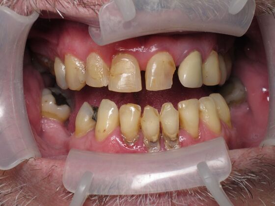 Full Mouth Implants: Full-Mouth Implants After Long-Term Dental Breakdown - Before