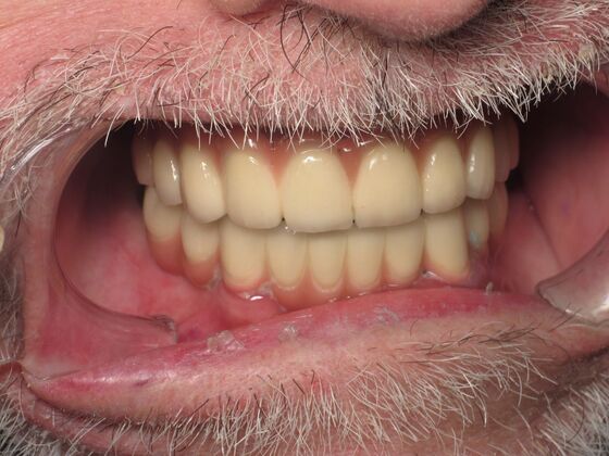 Full Mouth Implants: Full-Mouth Implants After Long-Term Dental Breakdown - After