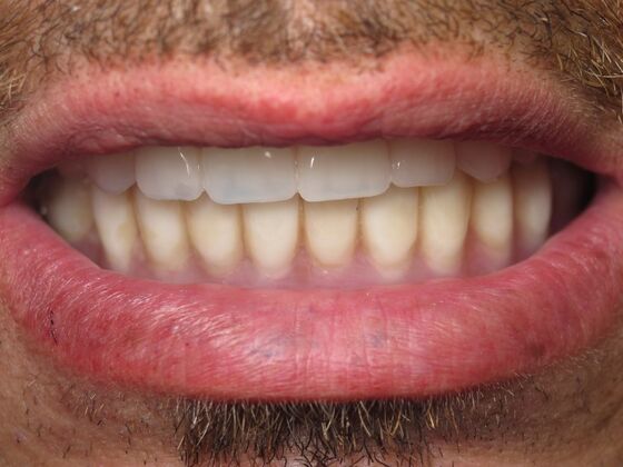 Full Mouth Implants: Full-Arch Implant Reconstruction for Missing and Damaged Teeth - After