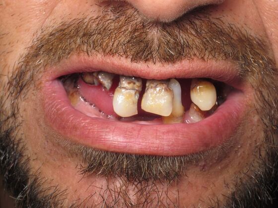 Full Mouth Implants: Full-Arch Implant Reconstruction for Missing and Damaged Teeth - Before