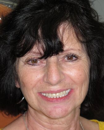 Full Mouth Implants: Denise