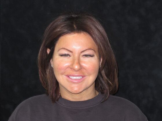 Laminates and Veneers: Christina