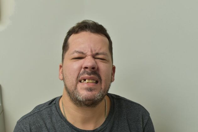 Full Mouth Implants Tosh